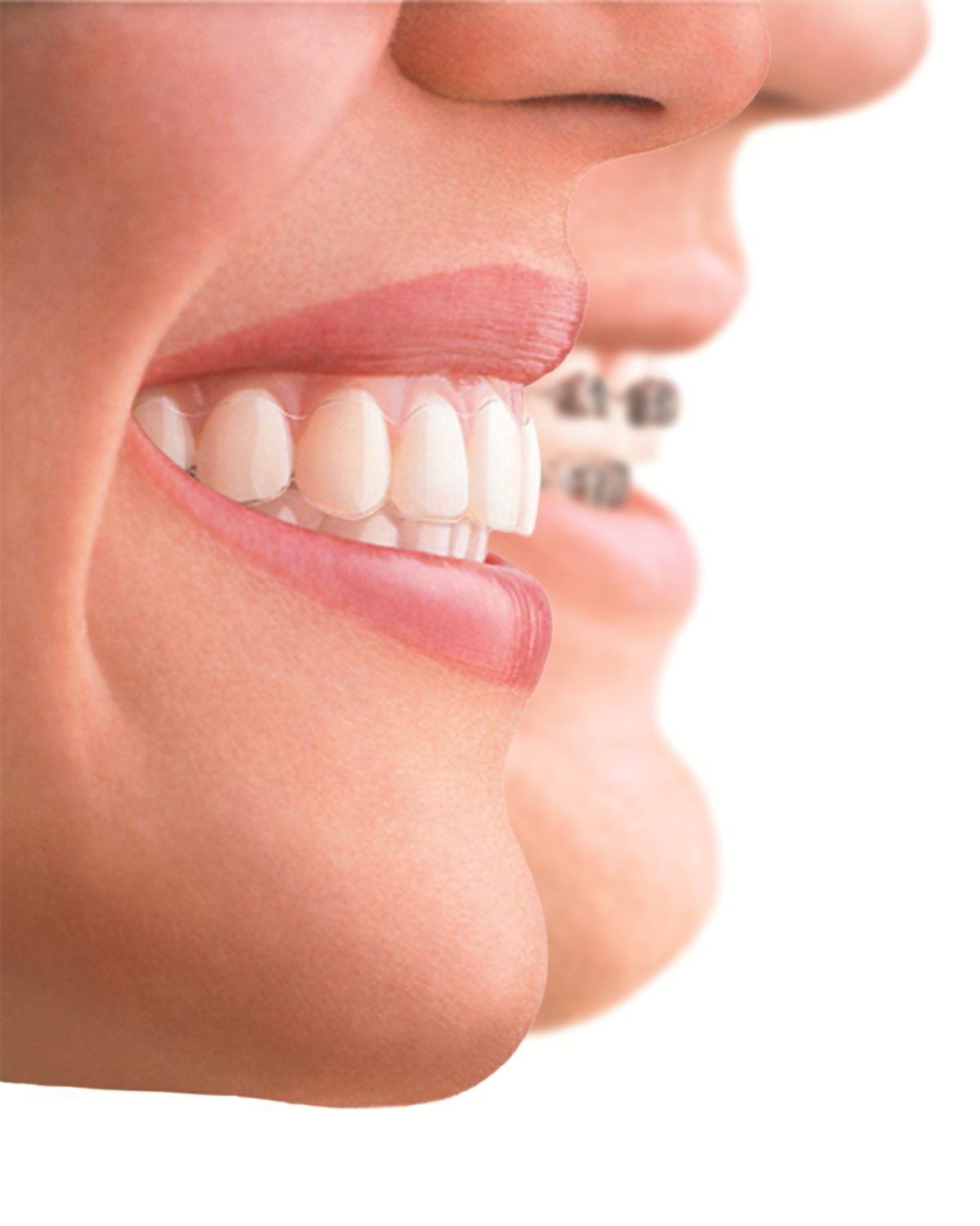 Richtige Mundhygiene bei Zahnspangen